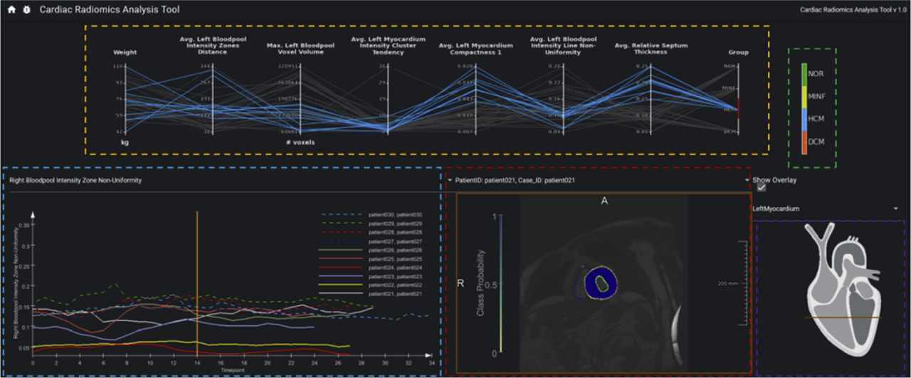 Figure 4: Exemplary screenshot of the exploration tool, with DCM cases selected (red range on the right-most axis). Visualization areas highlighted by dashed lines. Orange: Parallel coordinates plot. Green: Classes of the data set. Blue: Temporal curves for a specific feature. Red: Patient/case selection and 2D image slice with segmentation class probability overlaid. Purple: Schematic heart anatomy indicating the current slice.