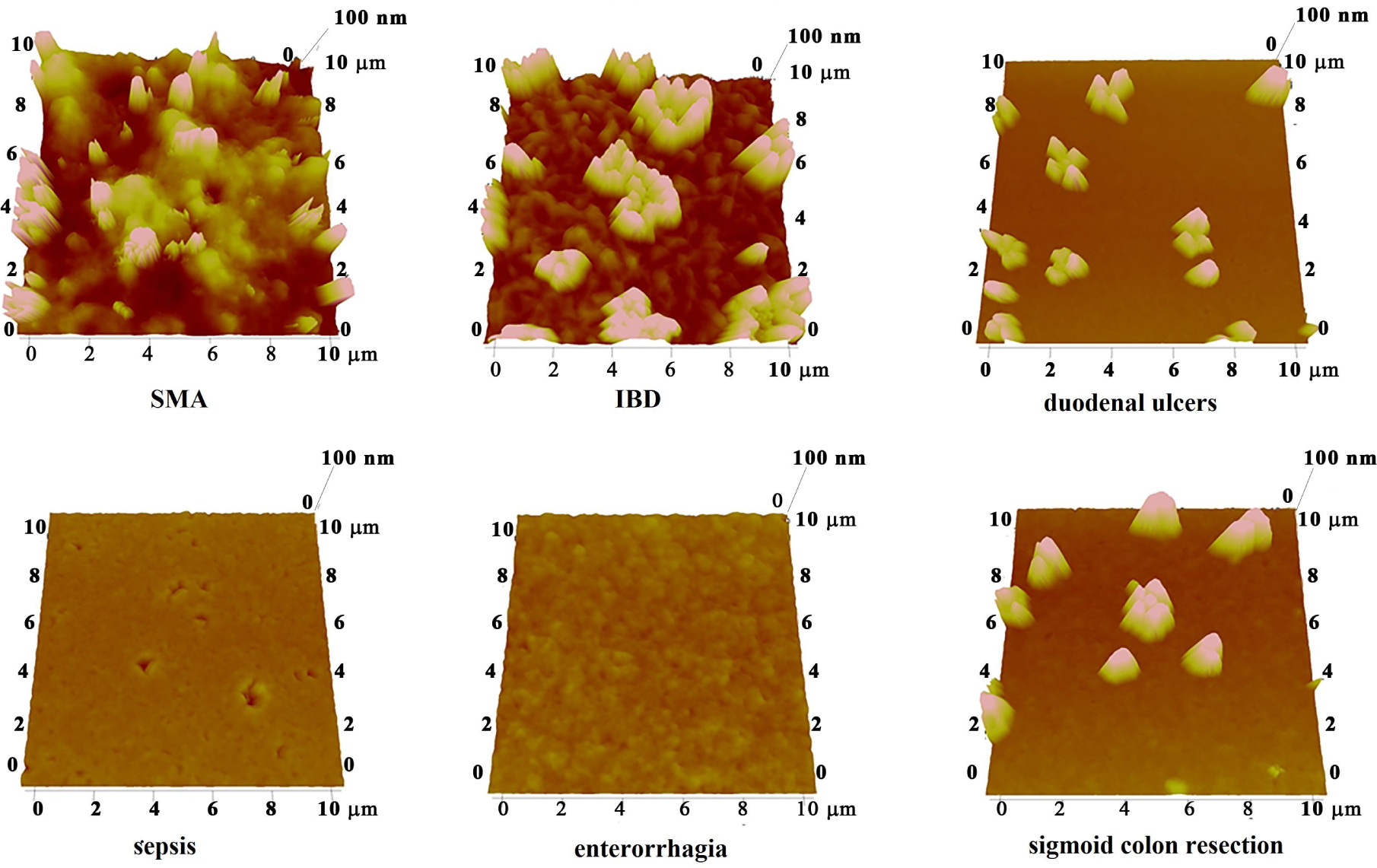 Figure 6 Surface of blood serum of selected ischemic patients suffering from superior mesenteric artery (SMA) thrombosis, inflammatory bowel disease (IBD), duodenal ulcers, sepsis, enterorrhagia, sigmoid colon resection.