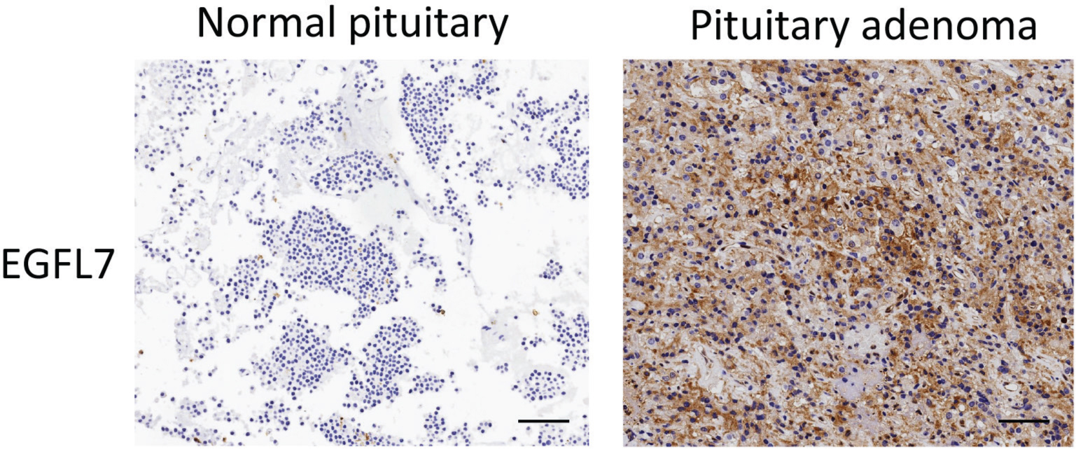 Figure 1 Overexpression of EGFL7 in prolactinoma tissues. Representative EGFL7 staining of TMA showed a significantly higher expression of EGFL7 in the cytoplasm of prolactinoma than in normal pituitary tissue. scale bar=200 μm.