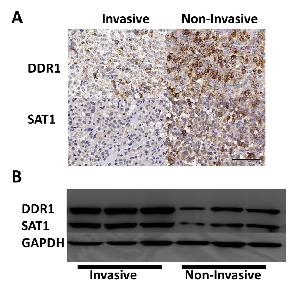 Figure 3 Analysis of miRNA-199a-5p target genes in prolactinoma specimens. A: IHC analysis of DDR1 and SAT1 expression in prolactinomas. Bar=60 μM. B: Western blotting analysis of DDR1 and SAT1 expression in prolactinomas.