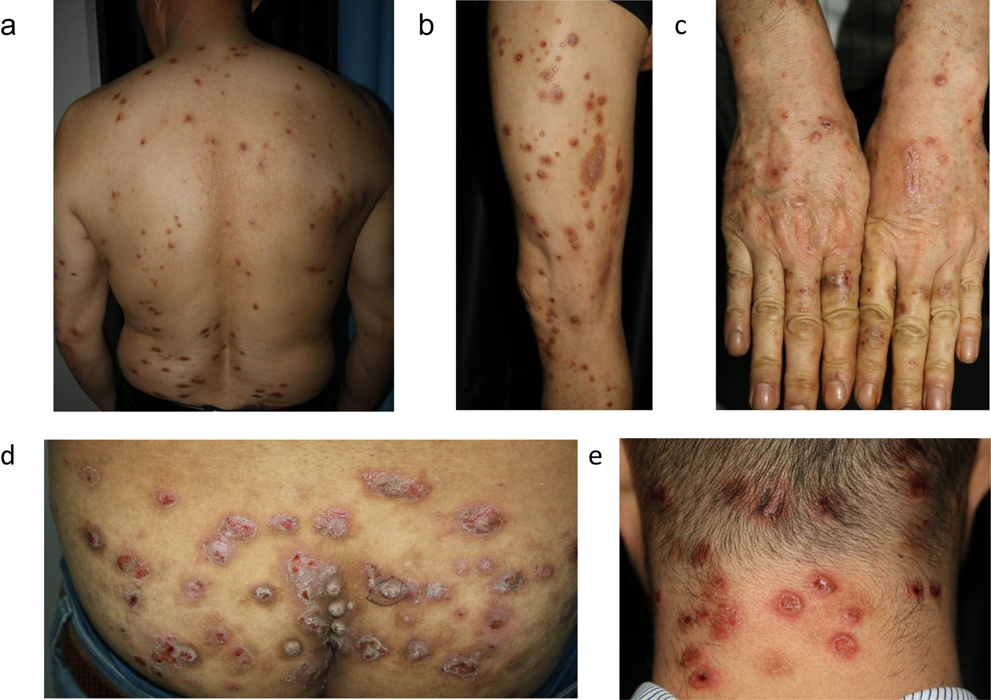 Figure 1 Clinicopathological features of prurigo nodularis. (a–e) Multiple excoriated papules or nodules involving typical distribution of trunk with the “butterfly sign” (no lesion on the center of the back), extensors of the extremities, palms, buttocks, and neck. These images were taken from five different patients with PN: (a) P36, (b) P23, (c) P26, (d) P18, and (e) P25.