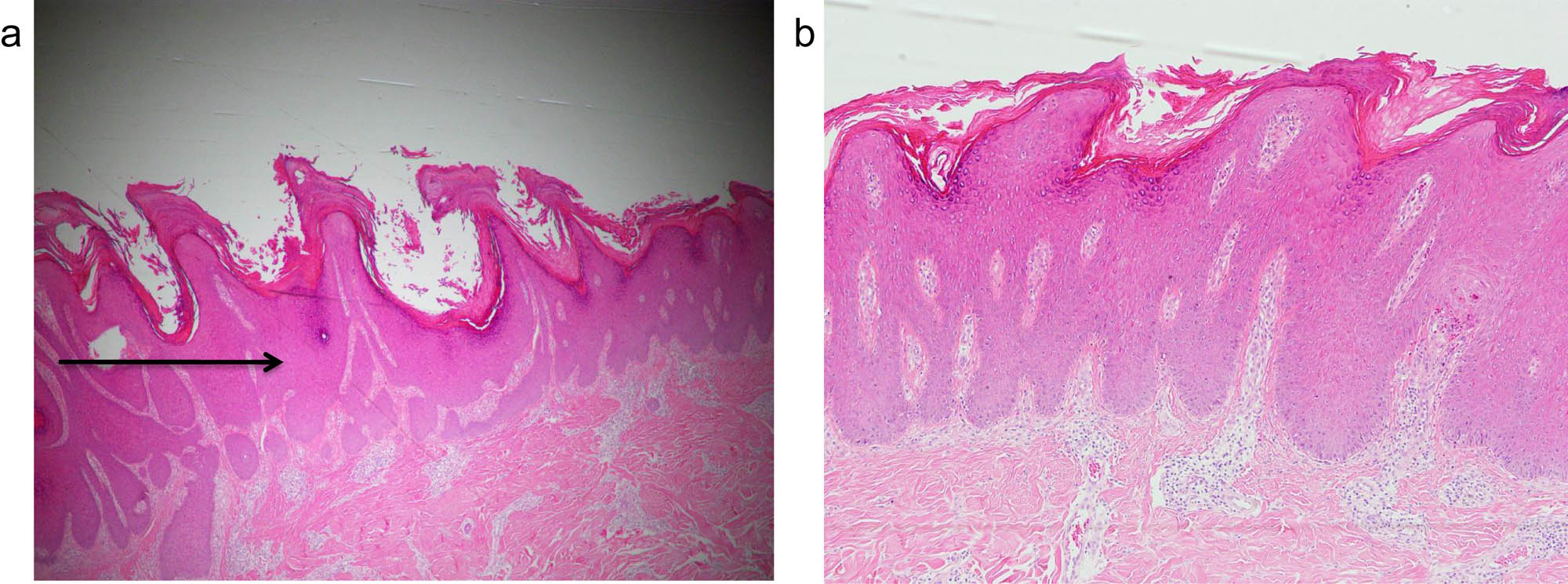 Figure 2 Histological observations of lesional skin biopsy from prurigo nodularis. Paraffin-embedded sections of lesional skin from PN stained with hematoxylin and eosin. Lesional skin biopsy showed orthohyperkeratosis, hypergranulosis, and epidermal hyperplasia (arrow); the epidermis mostly consisted of keratinocytes. (a) Original magnification ×40; (b) original magnification ×100.