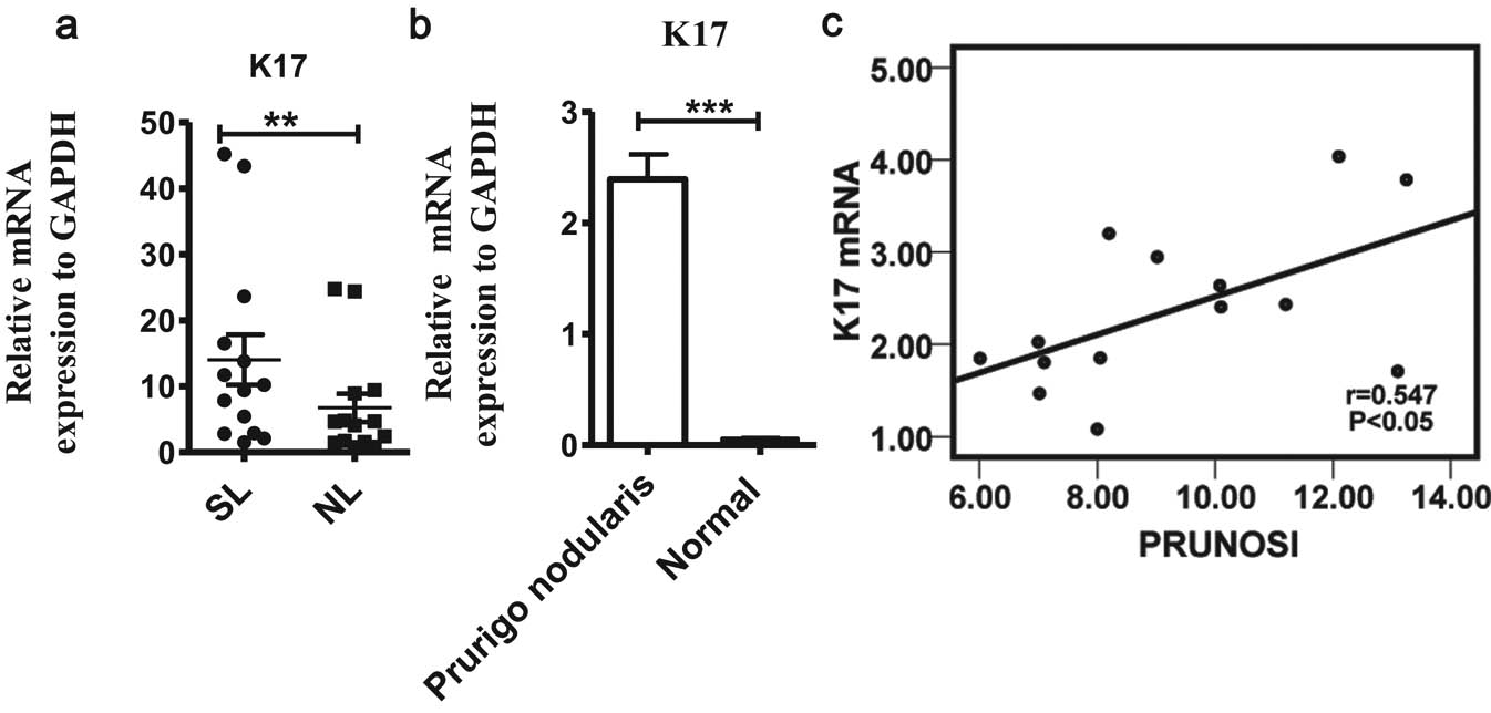 Figure 3 Keratin 17 (K17) mRNA expression levels in lesional and perilesional skin of patients with PN compared with those of healthy volunteers. (a) Real-time PCR analysis of K17 mRNA expression levels (n = 14). The levels are compared between the lesional skin and perilesional skin. (b) K17 mRNA expression levels are compared between the PN lesional skin and normal healthy skin. (c) Spearman analysis of PRUNOSI (x-axis) and K17 gene expression (y-axis); in the scatter plot, r = 0.547, *P < 0.05, regression line Y = 1.551x + 5.616, and regression coefficients R2 = 0.32. SL, lesional skin; NL, perilesional skin. Values show the expression/GAPDH level and are presented as mean ± SEM. Asterisks above the error bars denote comparisons between the matched lesional and perilesional skin. *P < 0.05, **P < 0.01, and ***P < 0.001, by paired Student’s t test.