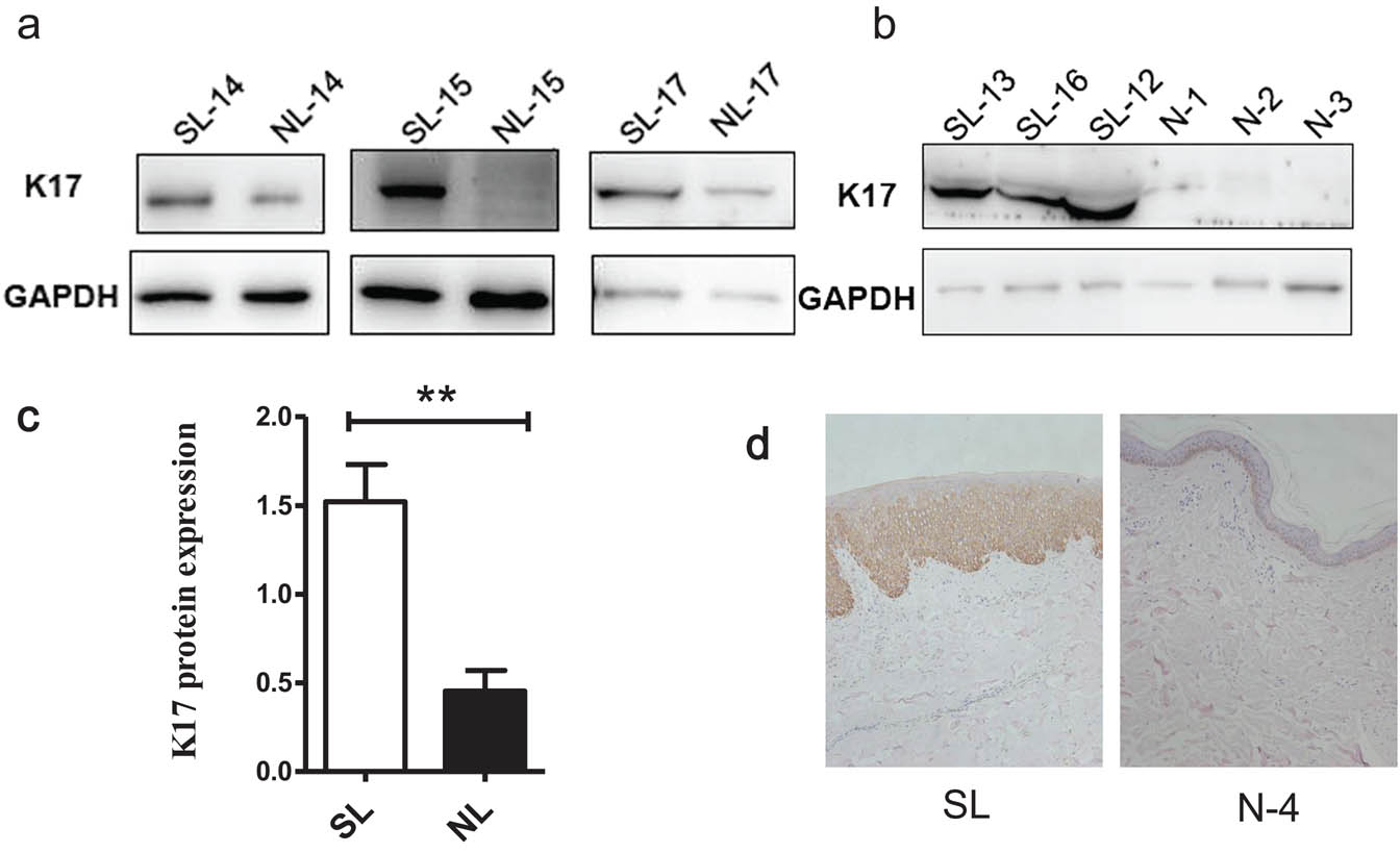 Figure 4 K17 expression is elevated in PN lesional skin. (a) Protein levels of K17 were detected in lesional skin and perilesional skin of patients with PN (n = 10) by Western blot and (b) protein levels of K17 from patients with PN and healthy controls (n = 9); (c) Image J analysis of K17 protein levels in lesional and perilesional skin. Band intensity was quantified by Image J. Values presented are the average of the K17 protein levels normalized to GAPDH from ten patients. (d) K17 expression in the PN lesional skin sample. Representative images of K17 expression are shown at 200 × magnification. SL, lesional skin; NL, perilesional skin; and N, normal control. **P < 0.01, by paired Student’s t test.