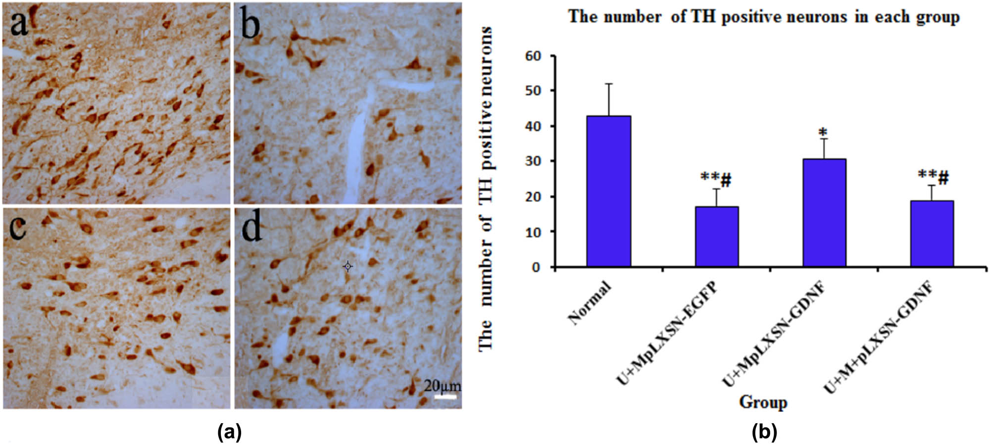 Figure 4 Quantification of the number of TH-positive neurons by immunohistochemistry analysis. (a) Determination of TH-positive neurons in each group; a: normal group; b: U + MpLXSN-EGFP group; c: U + MpLXSN-GDNF group; d: U + M + pLXSN-GDNF group; (b) analysis of TH-positive neurons in each group using ImagePro analysis software; compared with the normal group, *P < 0.05, **P < 0.01; compared with the U + MpLXSN-EGFP group and U + MpLXSN-GDNF group, #P < 0.05.