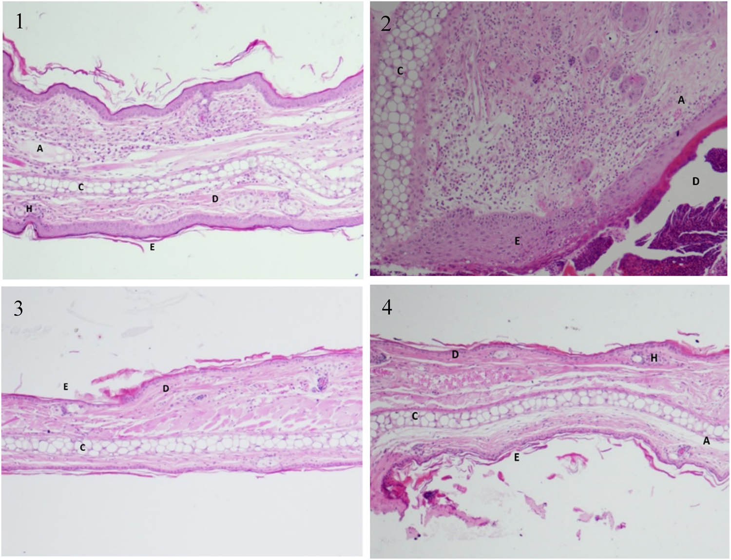 Figure 5
Hexane propolis extract reduced the histopathological alterations associated with ear inflammation/edema induced by croton oil. (1) Normal histological structures of the epidermal layer, dermal layer, and cartilage from an untreated ear. Note the absence of neutrophil infiltration. (2) Tissue treated with croton oil is showing infiltration of neutrophil in the dermis. (3) Tissue of ear treated with hexane propolis extract following croton oil showing virtually undamaged dermis and cartilage with little infiltration of cells. (4) Ear tissue treated with hexane propolis extract showing less of cells in the dermis compared to the croton oil-treated group. H, hair follicle; E, epidermis; D, dermis; C, cartilage; A, adipose tissue.