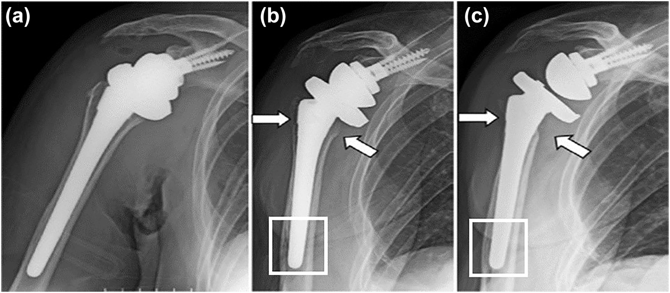 Figure 2: 
						Radiographs of humeral implants: (a) just after surgery, (b) 6 months, and (c) 1 year after surgery showing gradual loss of bone near the implant (arrow marked) and abnormal deposition of bone (rectangle region) far from the implant. Reprinted from (Inoue et al. 2020) with permission from Elsevier.
					