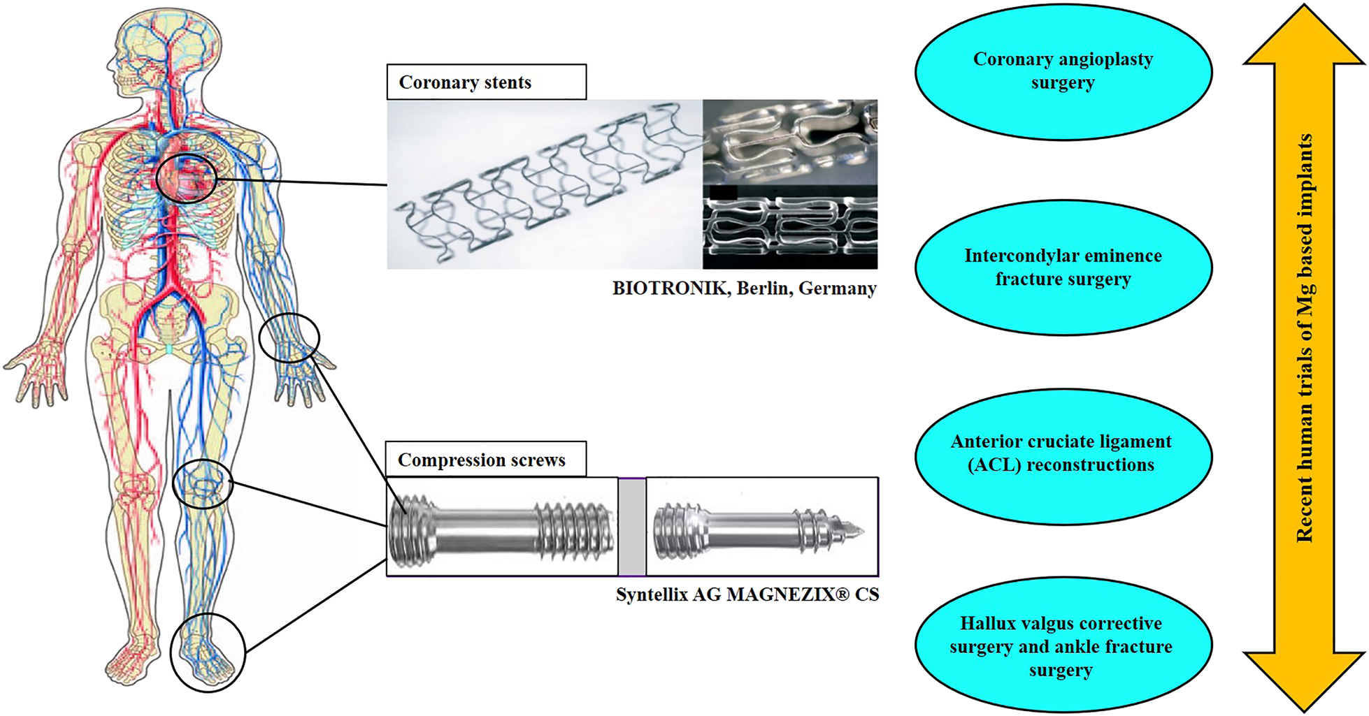 Figure 23: 
					Representative of the Mg-based implants which have been used in human clinical trials recently.
				