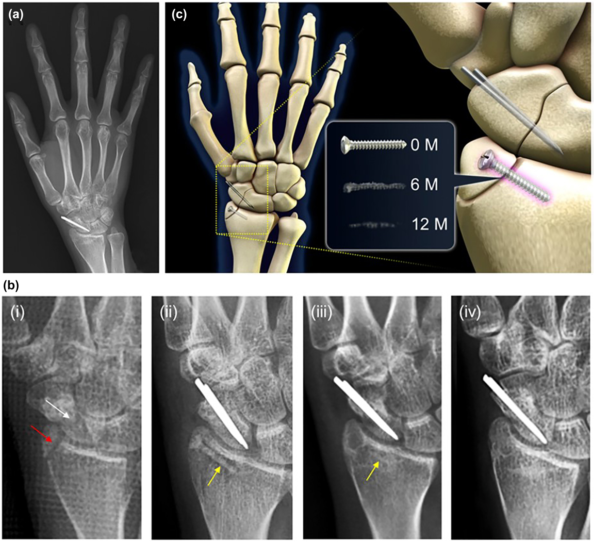 Figure 24: 
					X-ray images of (a) 1-year post-surgery of the distal radius fracture site showing complete degradation of Mg alloy screw with bone healing. (b) X-ray images showing (i) the distal radius fracture (red arrow) and the scaphoid nonunion (white arrow) before the surgical procedure, (ii) Mg–5wt%Ca–1wt%Zn alloy screw (yellow arrow) to fix the distal radius fracture and conventional stainless steel (SS) implant for the scaphoid nonunion, (iii) 6-month post-surgery, (iv) 1-year post-surgery. (c) Schematic representation of the fracture site depicting the progression of degradation process in the Mg–5wt%Ca–1wt%Zn alloy screw with time. Figure reproduced from Lee et al. (2016) with permission from PNAS.
				