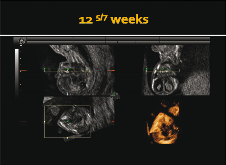 Figure 2
Three-dimensional rendered image of unilateral cleft lip and palate at 12 weeks and 5 days’ gestation.