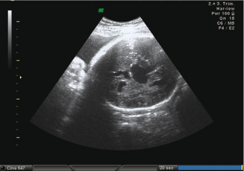 Figure 1
Vein of Galen aneurysm at color Doppler ultrasonography.