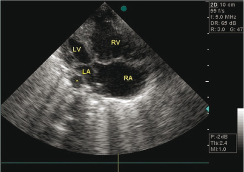 Figure 8
Atriums, ventricules and space behind left atrium on echocardiography.
