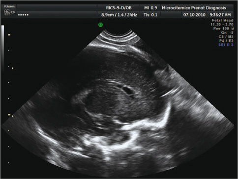 Figure 1 
					Periventricular pseudocysts detected by transvaginal ultrasound at 28 weeks plus 4 days.
					Thin septa are evident, which delimited three chambers for each side.
				