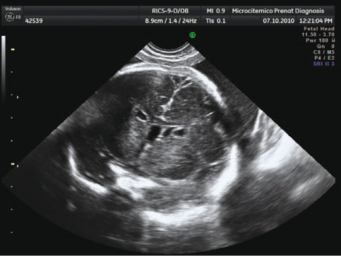 Figure 2 
					Prenatal ultrasound at 28 weeks plus 4 days obtained by sweeping the three-dimensional volume.
					Periventricular pseudocysts were located below the angle of the outer edge of the lateral ventricles in the coronal plane.
				