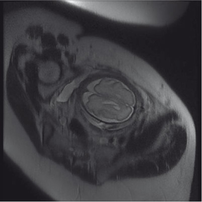 Figure 3 
					Prenatal MRI at 29 weeks plus 1 day.
					Single-shot fast spin-echo T2 coronal image confirms the cystic-signal cerebrospinal fluid localized in the periventricular zone.
					Thin septa are evident, which delimited three chambers for each side.
				