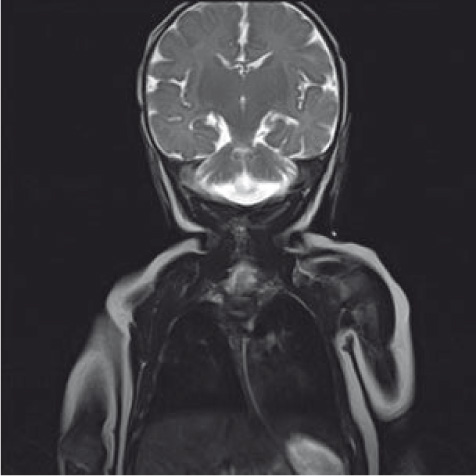 Figure 2 
					MRI head demonstrating cerebellar and pontine hypoplasia.
				