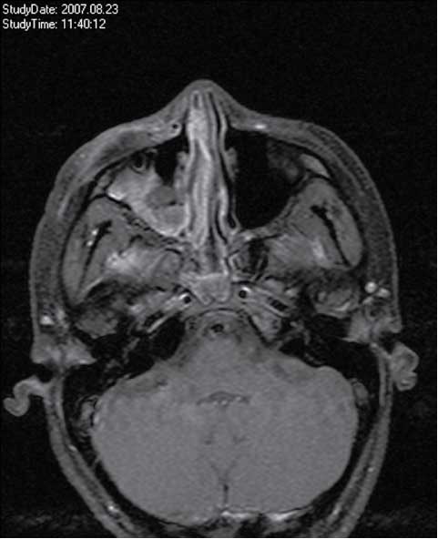 Figure 2
Retrobulbar hemorrhage after surgical intervention.