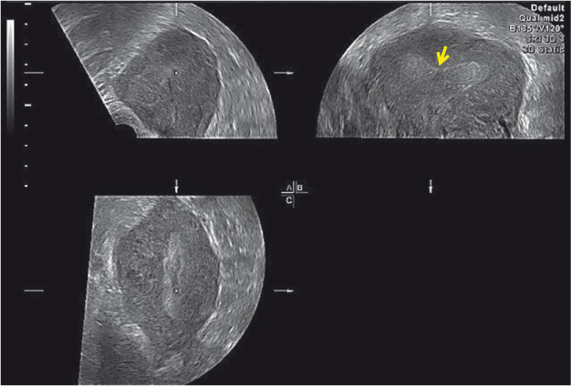 Figure 1
A multiplanar view by 3-D US demonstrating an arcuate uterus in the coronal plane (indicated by arrow).