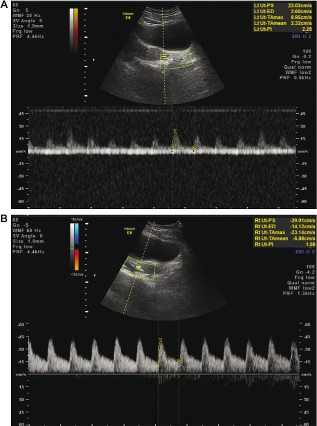 Figure 2
Pulsed Doppler waveform signals obtained from the left uterine artery demonstrated a PI of 2.28 (A). Pulsed Doppler waveform signals obtained from the right uterine artery demonstrated a PI of 1.08 (B).