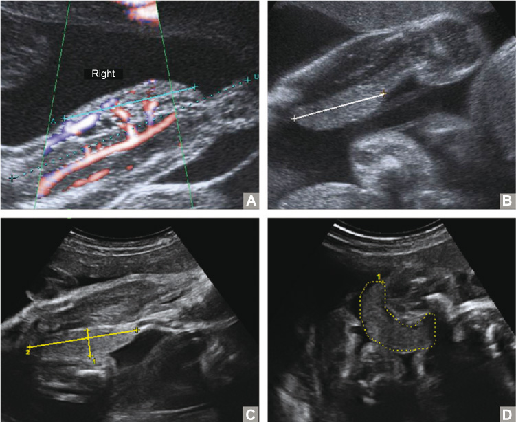 Figure 1 
					US images. 
					(A) First US at 23+1 weeks of gestational age showing a mass on the mediodorsal side of the right lower leg, ~2.7 cm in length (cyan line). Doppler imaging shows extended vascularity of the lesion with afferent and efferent vessels. (B) On US at 28+6 weeks of gestation, the well-defined homogeneous soft tissue mass has extended to a length of 3.9 cm (white line). (C) US at 32+6 weeks of gestation showing an increasing size of ~1.5×5 cm (yellow lines). (D) On the same US, incomplete circumferential growth of the tumor is visible (circumference 11.3 cm, yellow dotted line).
				