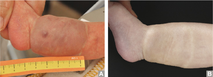 Figure 2 
					Photographs.
					(A) Deep hemangioma of the right lower leg with a length of ~5 cm. (B) Outpatient follow-up shows impressive discoloration and shrinking of the hemangioma 6 months after birth.
				
