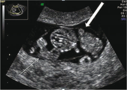 Figure 1 
					Detailed transvaginal US at 8 weeks of gestational age showed a fetus with normal growth and a second poorly delineated mass with a single slowly beating heart (89/min).
					White dashed arrow, abnormal mass; white arrow: normal fetus.
				