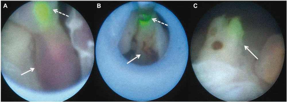 Figure 2 
					Fetoscopic view before, during, and after coagulation and transection of the umbilical cord using a diode laser.
					White dashed arrows point to the green pilot light (A) and the laser fiber itself (B). White arrows show the umbilical cord of the acardiacus before (A), during (B), and after coagulation and transection (C).
				
