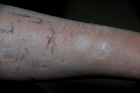 Figure 3 
					Close-up left forearm.
				