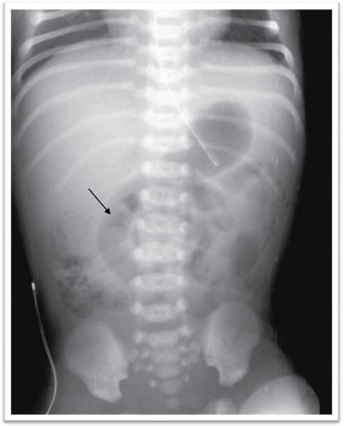 Figure 1 
					Abdominal X-ray showing a fixed loop and outlining a whirlpool sign (arrow).