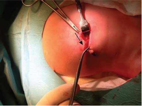 Figure 2 
					Intraoperative photograph of the appendix (arrow).