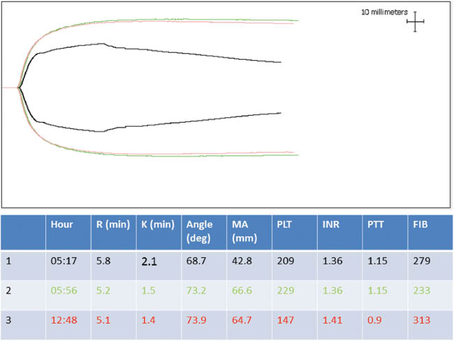 Figure 2
Thromboelastography (TEG) of the first case.
Trace 1 (black) was measured during administrating 8 units of plasma, 16 units of platelets, and 20 units of cryoprecipitate to the patient. It shows a decrease in the strength of the clot (low maximal amplitude). The second trace 2 (green) was recorded about 40 min later and it shows TEG parameters within normal limits. The third trace (red) was taken after the patients received 2 units of plasma, 5 units of platelets, and 10 units of cryoprecipitate. It is similar to the second trace.