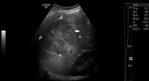 Figure 1: 
					Abdominal ultrasound of the maternal liver noting interval increase in size of known right hepatic lobe hemangioma (arrow).
				