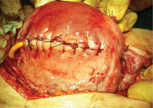Figure 3: 
						The another intraoperative image of the uterus.
					