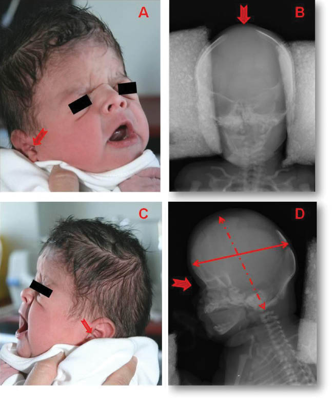 Figure 1: 
					Physical dismorphias (A, C) compared to AP and lateral cranial X-ray images (B, D): turricephalic forehead.
					Shortening of the anterior-posterior cranial diameter. Flat occiput. Low hair implantation. Wide normotensive anterior fontanelle (see wide red arrow). Bulging forehead. Flat face with antimongoloid palpebral fissures. Exotropia. Depressed nasal bridge. Maxillary hypoplasia. Low-set ears with “horizontal cross helix” sign (see narrow red arrow).
				