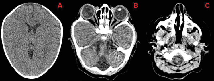 Figure 2: 
					Cranial scanner images.
					(A) Ventricular asymmetry because of a slight enlargement of the left lateral ventricle. (B) Bilateral exotropia. (C) Deviated nasal septum.
				