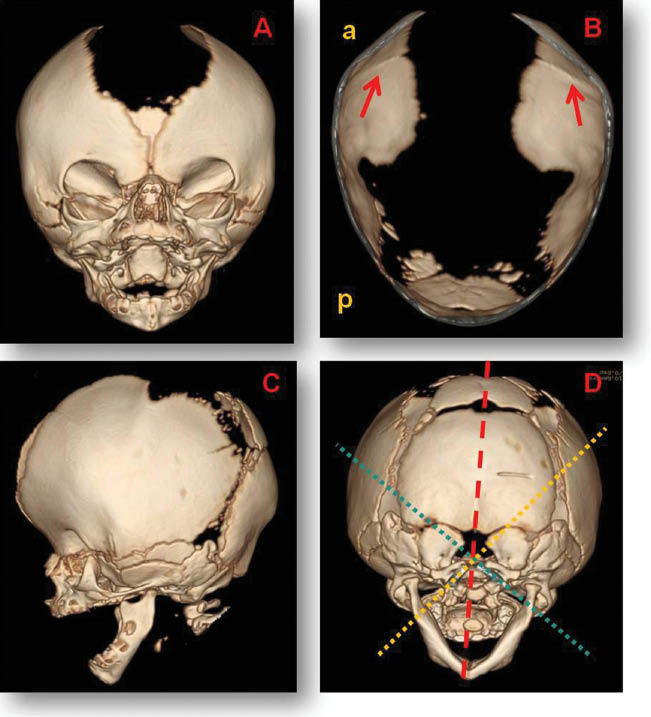 Figure 3: 
					3D Cranial scanner images.
					(A) Wide anterior fontanelle. (B) Bilateral coronal suture fusion and wide sagittal suture defect and posterior fontanelle [a: anterior, p: posterior]. (C) Turricephaly forehead. (D) Cranial asymmetry.
				