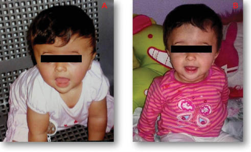 Figure 4: 
					Before and after neurosurgery acrocephaly correction. (A) 8 months of life. (B) One year old.
				