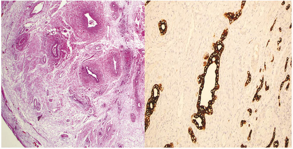 Figure 5: 
					Image on left represents a hematoxylin and eosin stain at low power magnification. Image on right represents a cytokeratin immunohistochemical stain highlighting bile ducts.
				