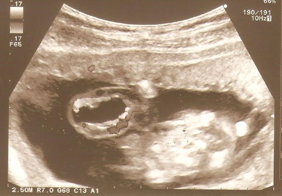 Figure 1:
Ultrasound examination at the 14th week of gestation revealing an anechoic cystic mass measuring 4.2 mm in diameter located in the central part of the cord with the umbilical vessels located against the outer wall detected by colour Doppler.
