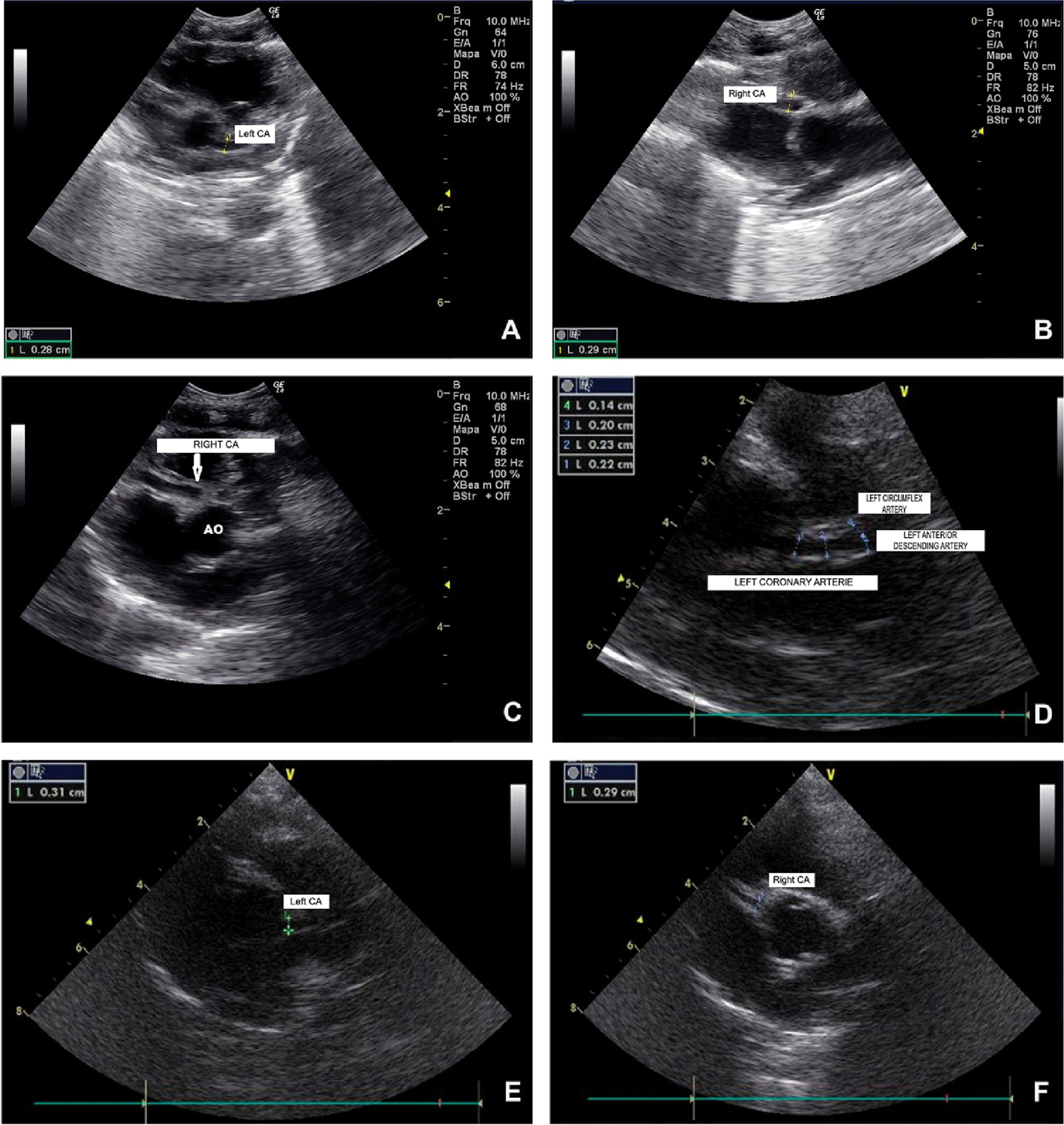 Figure 1: 
Consecutive echocardiograms of the newborn, performed on the 5th (1A and 1B) and the 10th day postpartum (1C), and subsequently on the 7th (1D) and the 10th month of life (1E and 1F), showing the appearance of bilateral coronary artery aneurysms and their eventual final normalization.
