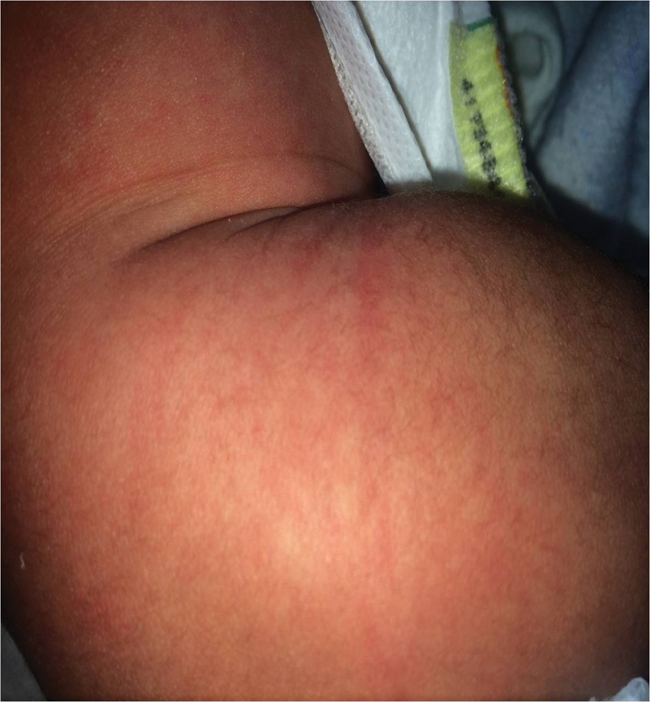 Figure 2: 
Polymorphic rash, characteristic of Kawasaki’s disease, appeared after the 5th day.
