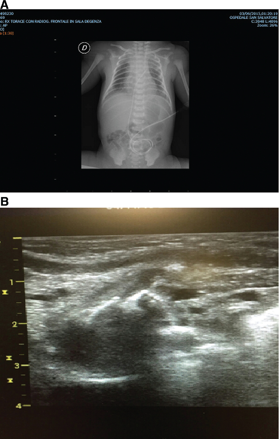 Figure 1: 
(A) Chest X-ray at the beginning in case 1: radiolucent area susceptible for pneumatocele at medio-basal right lung. (B) LUS at the beginning in case 1: intrapulmonary multilobed cyst below the pleural line with a thin hyperechoic outside wall and a hypoechoic centrum.
