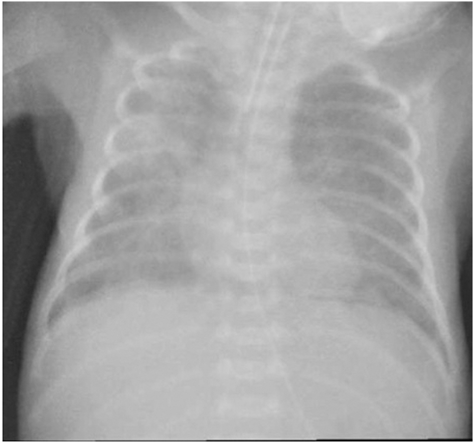 Figure 1: 
Chest radiograph, 8 days of age, showing asymmetric multifocal areas of opacity.
