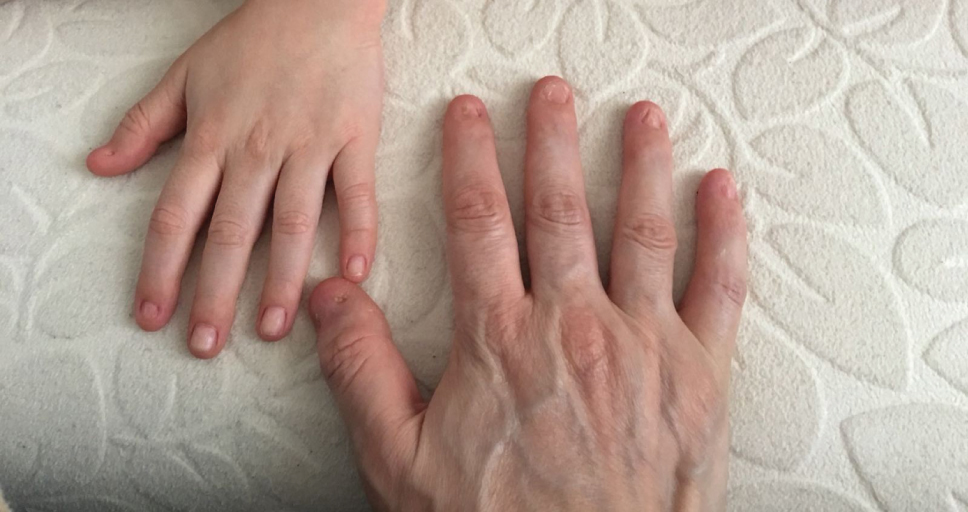 Figure 1: 
Nail hypoplasia of affected child and mother.
