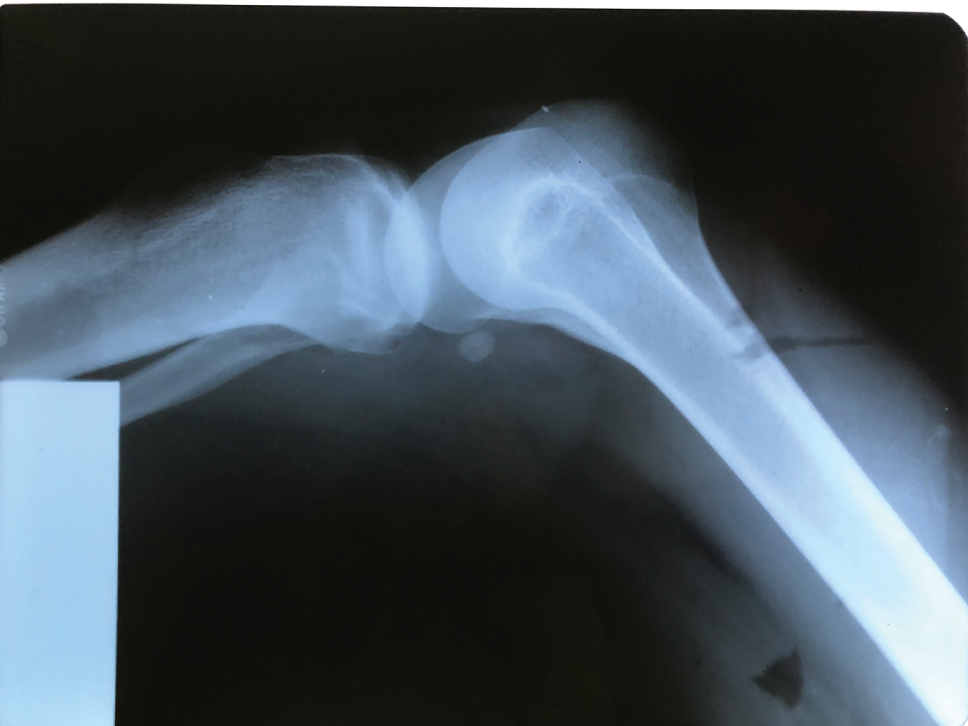 Figure 2: 
X-ray of the knee joint of the affected child.
