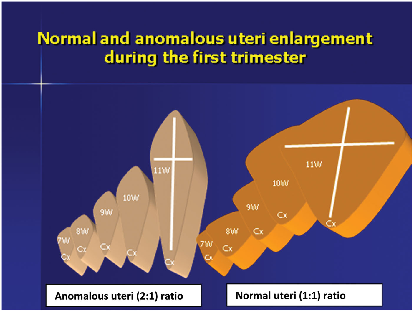 Figure 4: 
A schematic illustration of a normal and anomalous uteri enlargement during the first trimester from week 7 to 11 of gestation.
