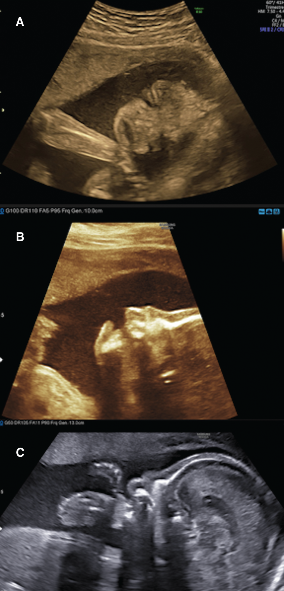 Figure 1:
Eclabium and ectropion on the coronal axis of the face; (A) Eclabium and ectropion on the coronal axis of the face; (B) hypoplastic nasal bone and eclabium on the profile view; (C) hypoplastic nasal bone on a strictly median sagittal axis of the head (corpus callosum completely viewed).
