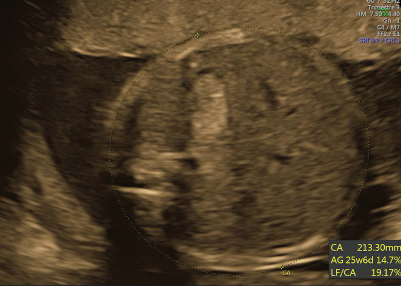 Figure 2:
Intragastric hyperechoic image.