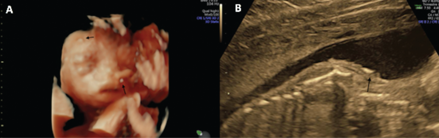 Figure 3:
Skin scaling on 3D reconstruction of the face and on the shoulder.
Black arrows on Figure (A) and (B).