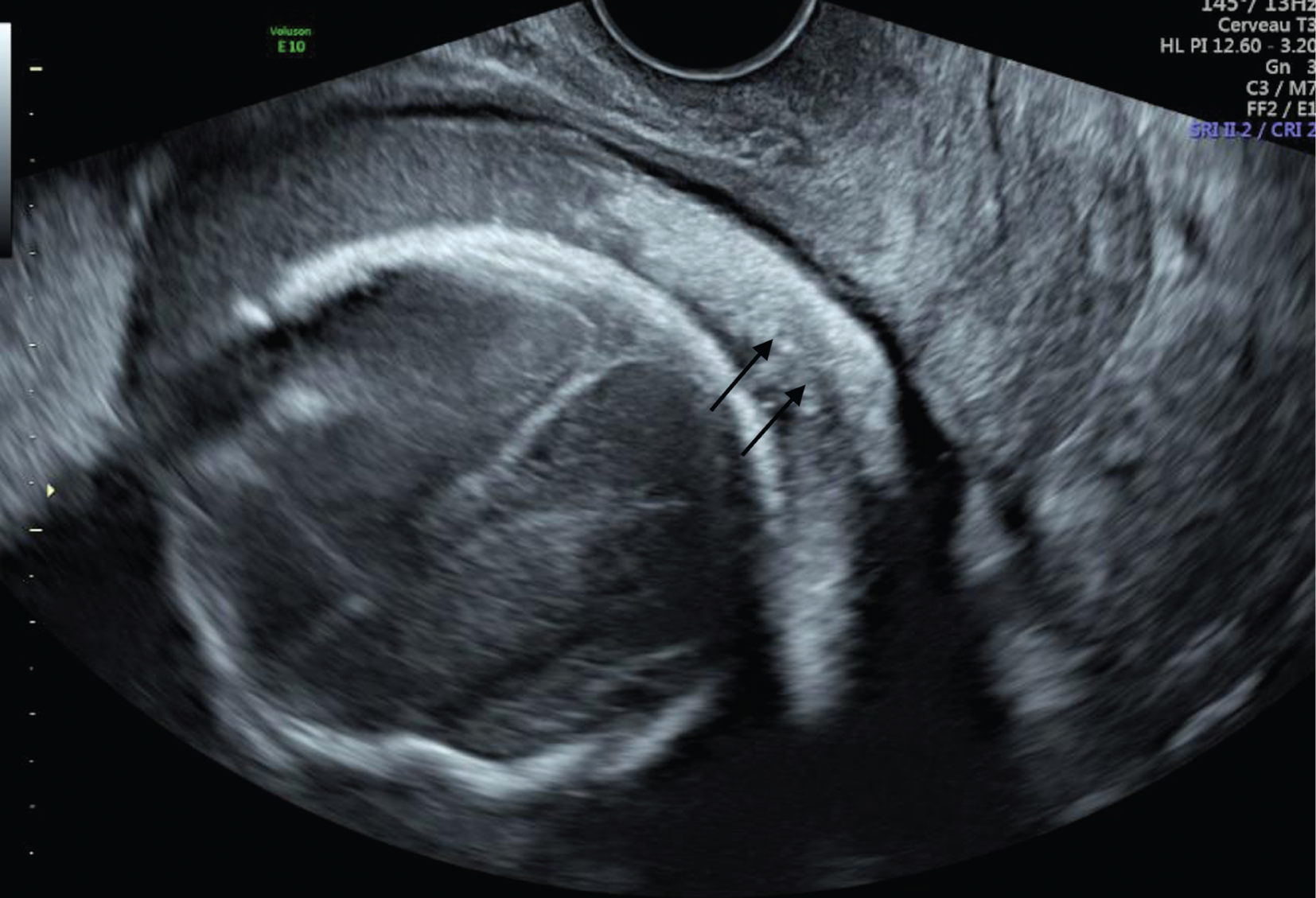 Figure 4:
Amniotic liquid hyperechoic and skin scales sedimentation observed at vaginal ultrasound, just above the cervix (black arrows).